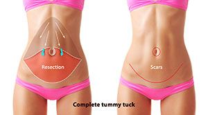 Abdominoplasty Austin Tx