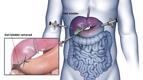 Gallbladder Surgery