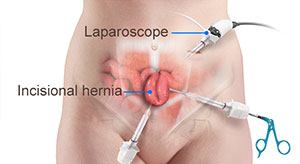 Incisional Hernia Repair