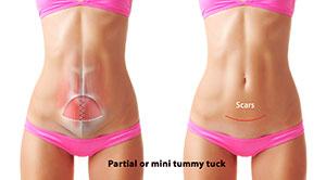 Partial or mini tummy tuck