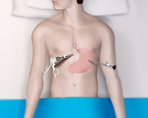 Laparoscopic (Keyhole) Stomach Surgery