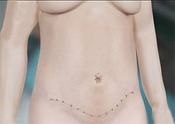 Complete tummy tuck