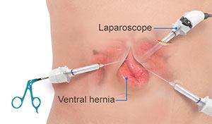 Ventral Hernia Repair